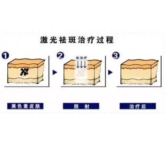 美莱微整形:都是玻尿酸,水光针和填充用的什么差别
