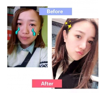 上海美容医院打瘦脸针的危害你知道多少?