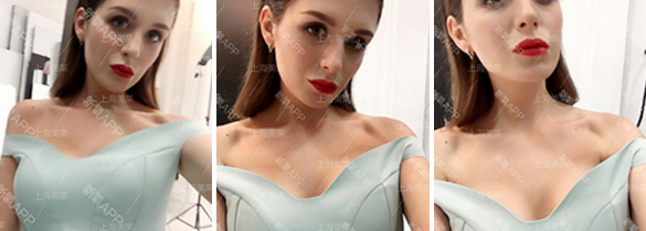 美莱一张图来告诉你上睑下垂和双眼皮的区别!