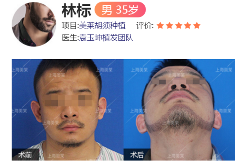 在美莱做完激光点痣后多久能碰水?还要注意哪些?