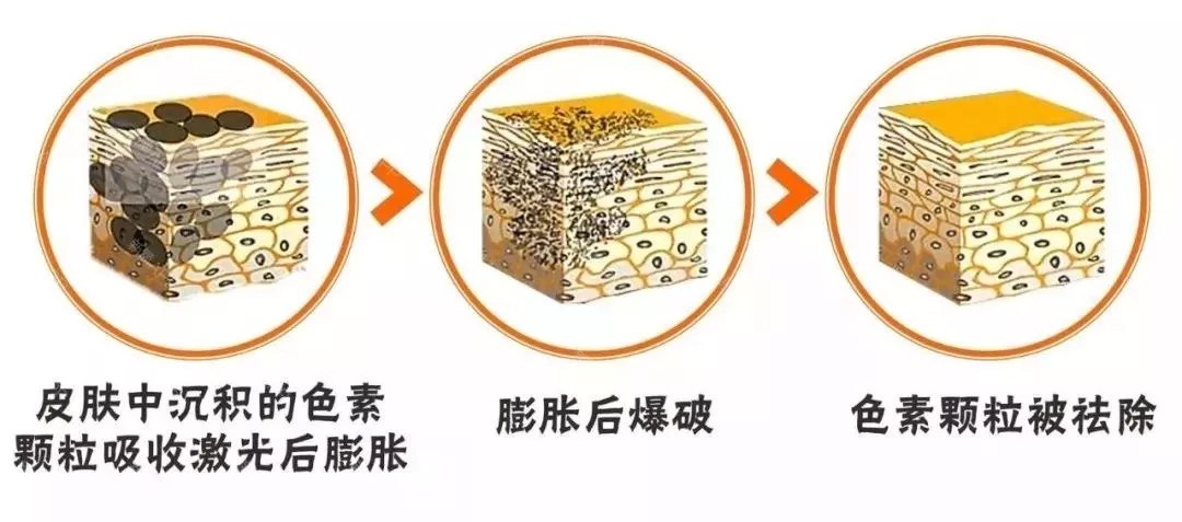 美莱医生推荐大家使用镭达光去雀斑!