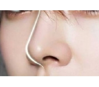 什么是瓷贴面?美莱科普!