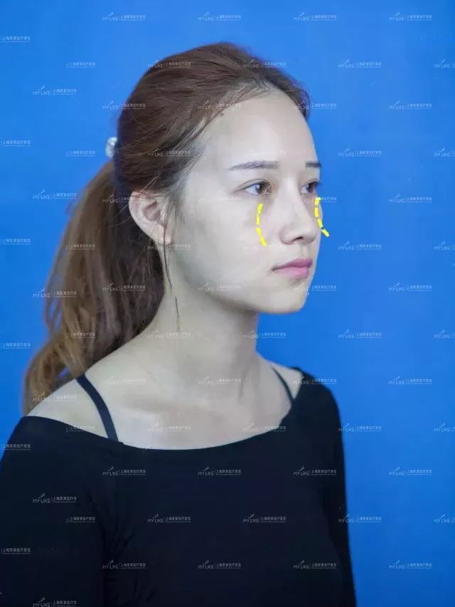 上海激光祛斑反黑正常吗?