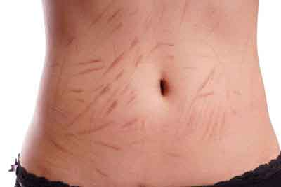 上海美莱做除皱,打玻尿酸的效果好吗