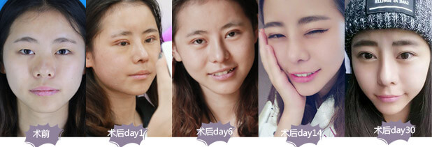 祛痘好季节,听听美莱怎么能快速祛痘?