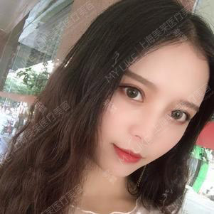 去除眼部鱼尾纹,美莱玻尿酸抵制您的鱼尾纹!