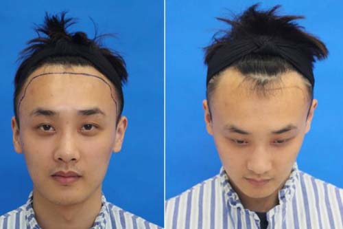 上海注射瘦脸针医院价格贵不贵,选择美莱多优惠!