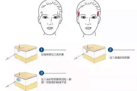 上海做开眼角手术价格,美莱吴海龙为我们说明~