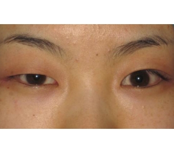 上海做开眼角手术价格,美莱吴海龙为我们说明~