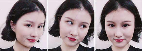 上海美莱何祥龙科普:眼部祛眼袋手术究竟多少钱