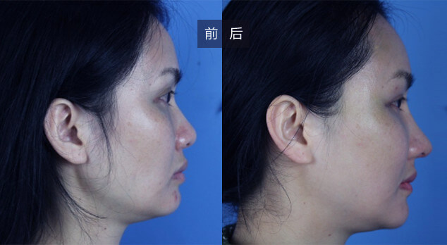 激光祛斑一般需要做几次?美莱医生科普!