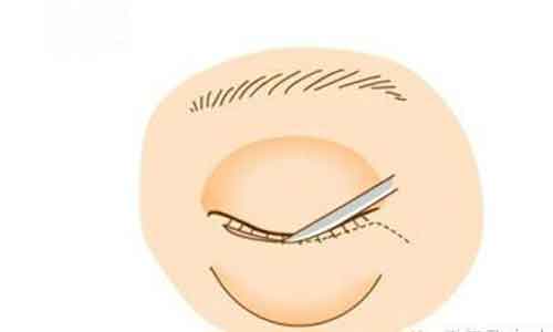 上海眼部修复,失败做全切双眼皮修复安全吗