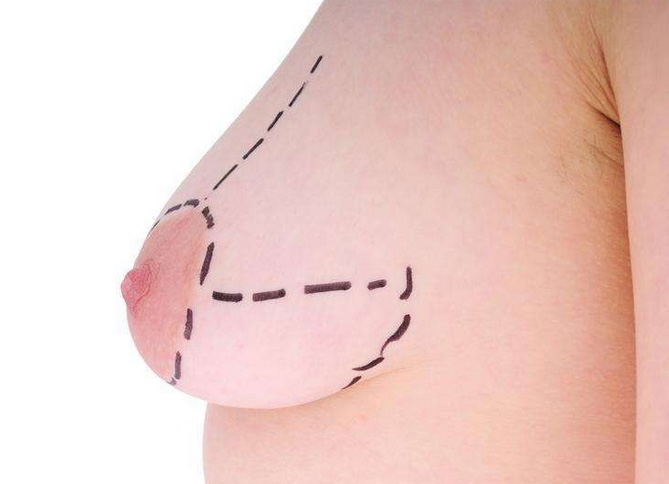 您明确自己开眼角损坏眼睛?上海美莱专业整形告诉您不可以!