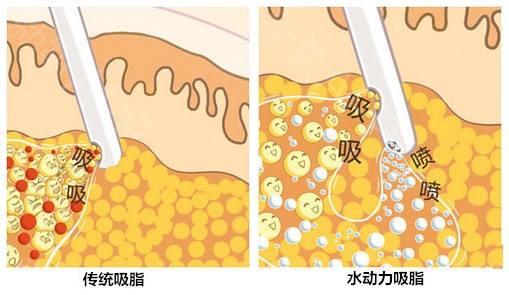 吸脂减肥的危害是什么?美莱科普!