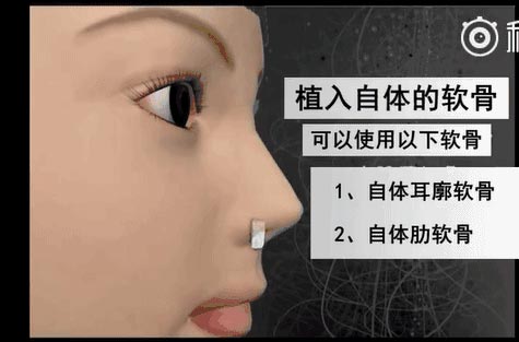 吸脂减肥的危害是什么?美莱科普!