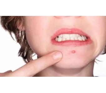 晒斑会自己消失吗?<a href='/' target='_blank'><u>上海美莱</u></a>祛斑医师告诉您!