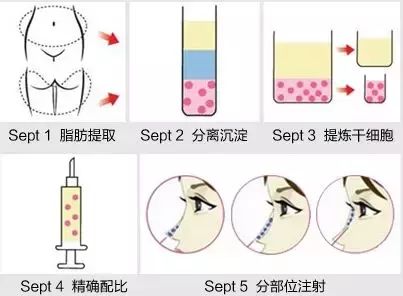 美莱医生告诉你:吸脂一次抽多少“脂肪”?