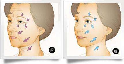 上海注射除皱的量一般是打多少?