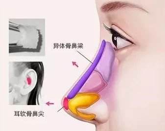 上海美莱整形·做脂肪丰胸有什么危险吗