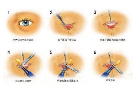 美莱微针祛痘痘痘印美容效果怎么样?