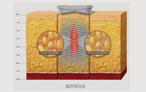 副乳存在—女人噩梦！上海美莱帮您快速去除副乳！