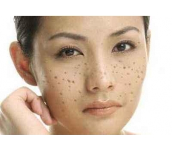 上海做鼻整形矫正手术,鹰钩鼻怎么办?