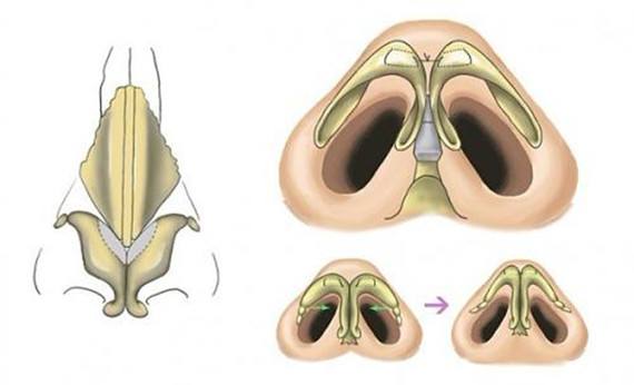 <a href='/' target='_blank'><u>上海美莱</u></a>王琳说—作自体软骨隆鼻失败还可以再修复吗
