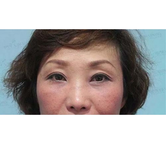 上海美莱为我们讲解|瘦脸针注射针作用原理