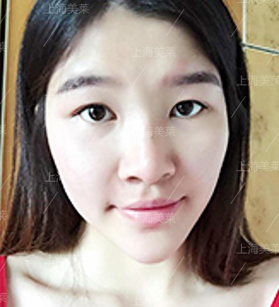 上海爱贝芙隆鼻好不好?