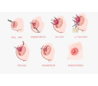 美莱激光祛斑需要多少钱?