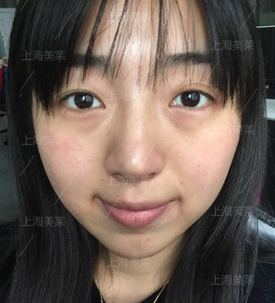 做开眼角手术会不会有副作用呢?<a href='/' target='_blank'><u>上海整形医院</u></a>?