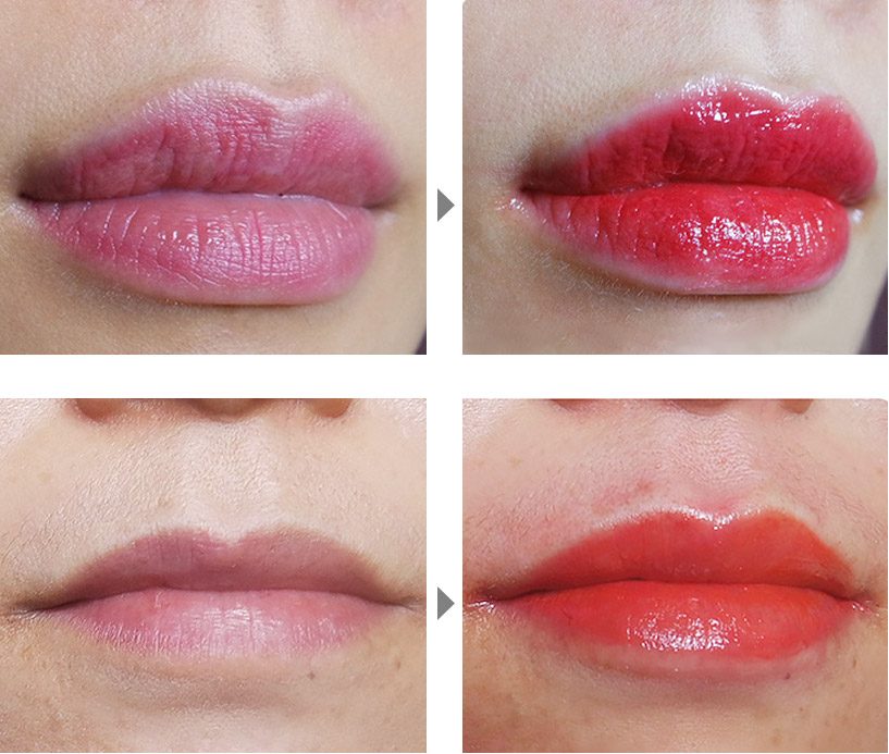 在上海美莱做完埋线后怎么快速消肿？