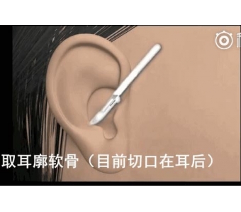 美莱光子嫩肤祛斑需要多少钱?