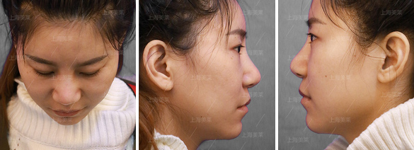 上海做去眼袋手术多少钱?