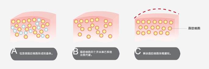 上海腹部抽脂的方法有几种?