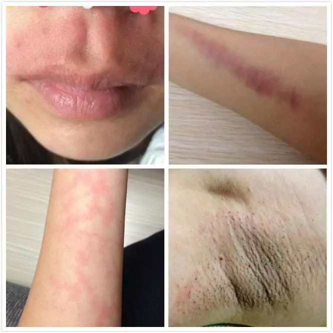 上海做祛斑哪家好,美莱告知男人脸上长斑什么原因?