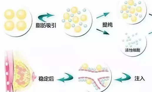 美莱玻尿酸丰下巴应该怎么护理?