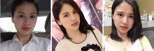 上海假体垫下巴需要麻醉么?