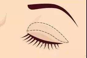 上海假体垫下巴需要麻醉么?