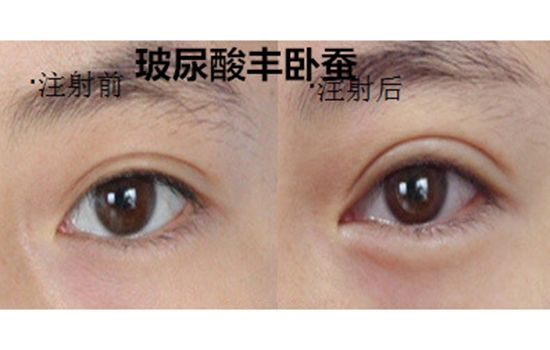 美莱医生告诉你:双眼皮术后护理是怎么样的?