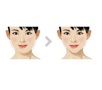 上海做软骨隆鼻会被吸收吗，为什么