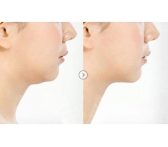 黄金微针、微针水光针有什么区别?美莱整形专家告诉你抗衰老