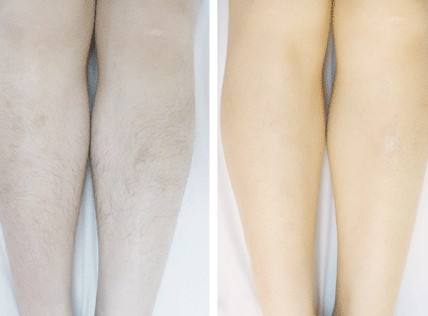 上海快速做全切双眼皮多少钱