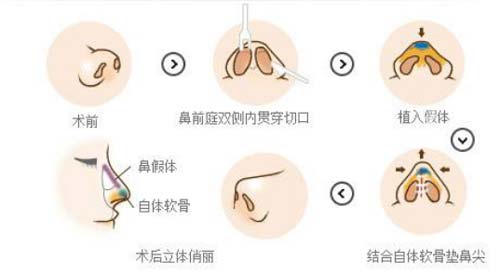 上海缩小鼻孔好吗,会不会留疤呢?