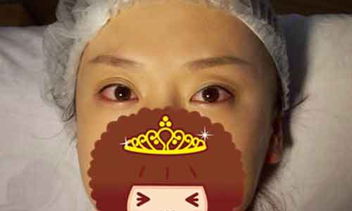 做了硅胶隆鼻注意事以及项术后恢复怎么弄