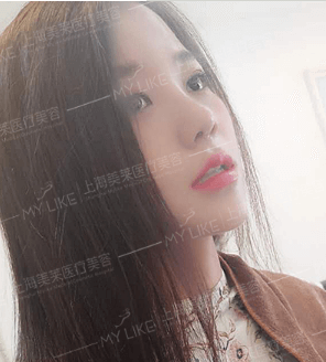 上海鼻子整形有效果吗?多久可以看见效果?