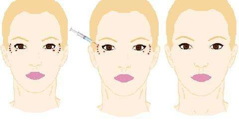 做脂肪隆胸与假体隆胸,哪种方式好?