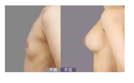 鼻翼的作用是什么?标准鼻翼是怎样的呢?