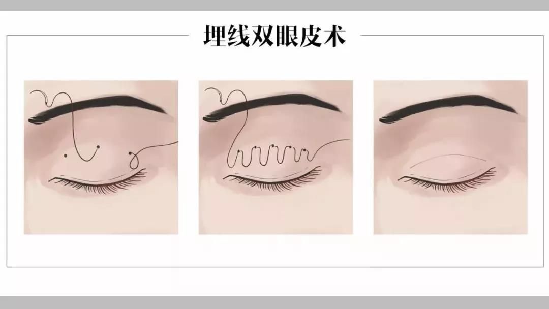 美莱丰苹果肌之后,给整张脸带来了怎样的变化?