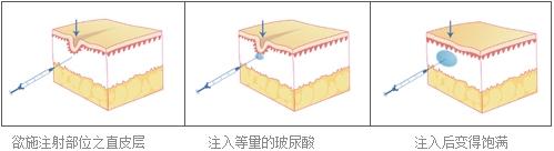 龅牙矫正手术,上海美莱矫正需要了解下